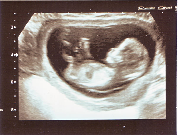 [img: ultrasound scan 12w 6d]